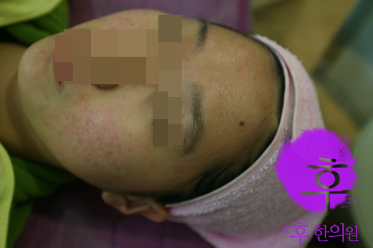 인천 홍조 동반 여드름 치료 후 사진