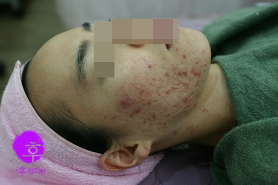 인천 염증성 면포성 여드름 치료 전 사진