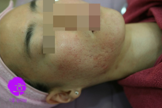 인천 염증성 면포성 여드름 치료 후 사진