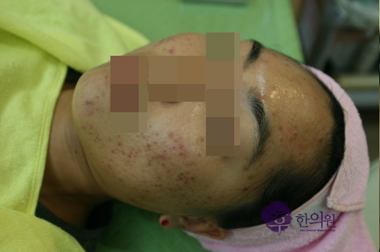 인천 얼굴 염증성 여드름 치료 전 사진
