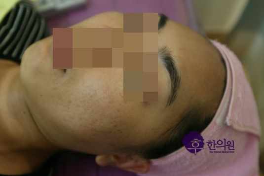 인천 얼굴 염증성 여드름 치료 후 사진