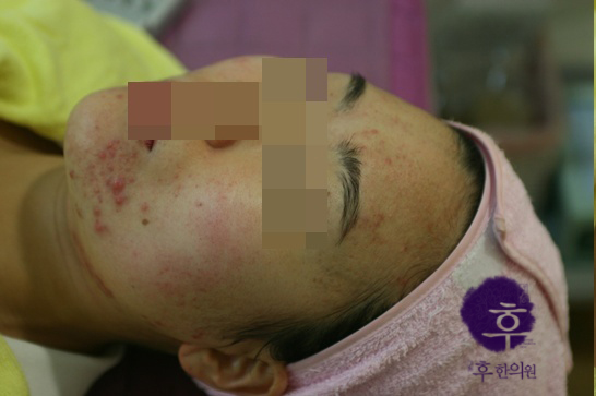 인천 20대 턱 볼 여드름 치료 전 사진