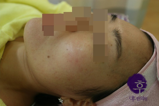 인천 20대 턱 볼 여드름 치료 후 사진
