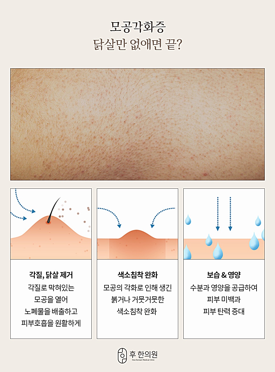 모공각화증 관리 포인트 3가지 안내, 각질·닭살 제거·색소침착 완화·보습과 영양 공급
