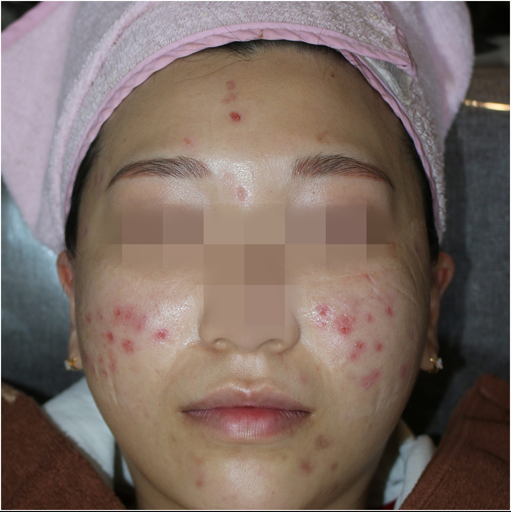 인천흉터치료 약물 케어 후 살펴 본 피부의 사진