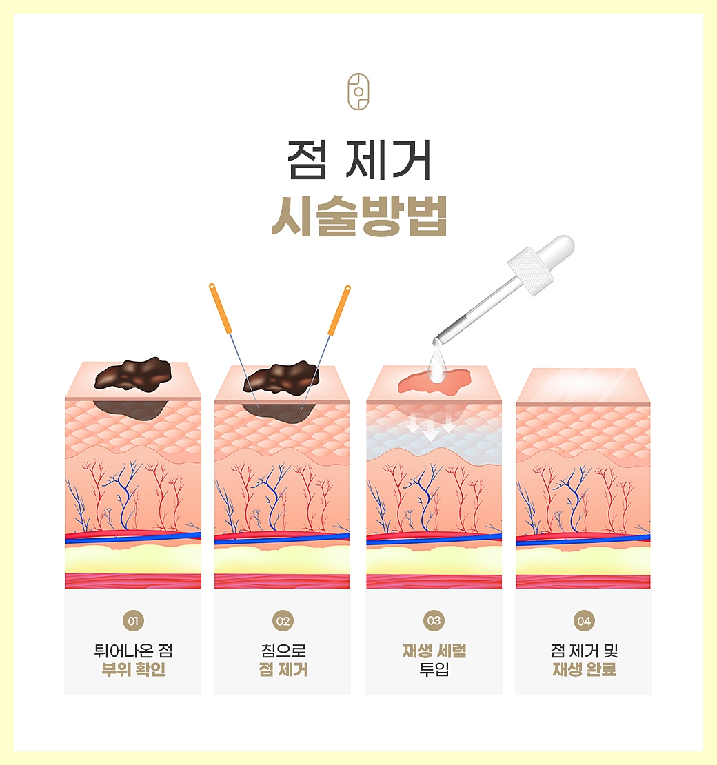 한의원의 점제거 시술 타이포그래피 이미지