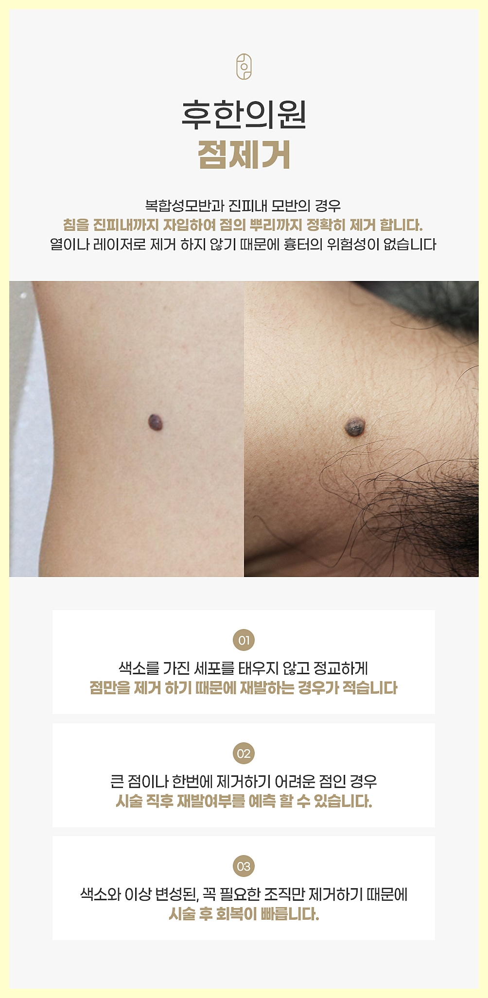 점제거 시술의 특징을 항목별로 정리한 이미지
