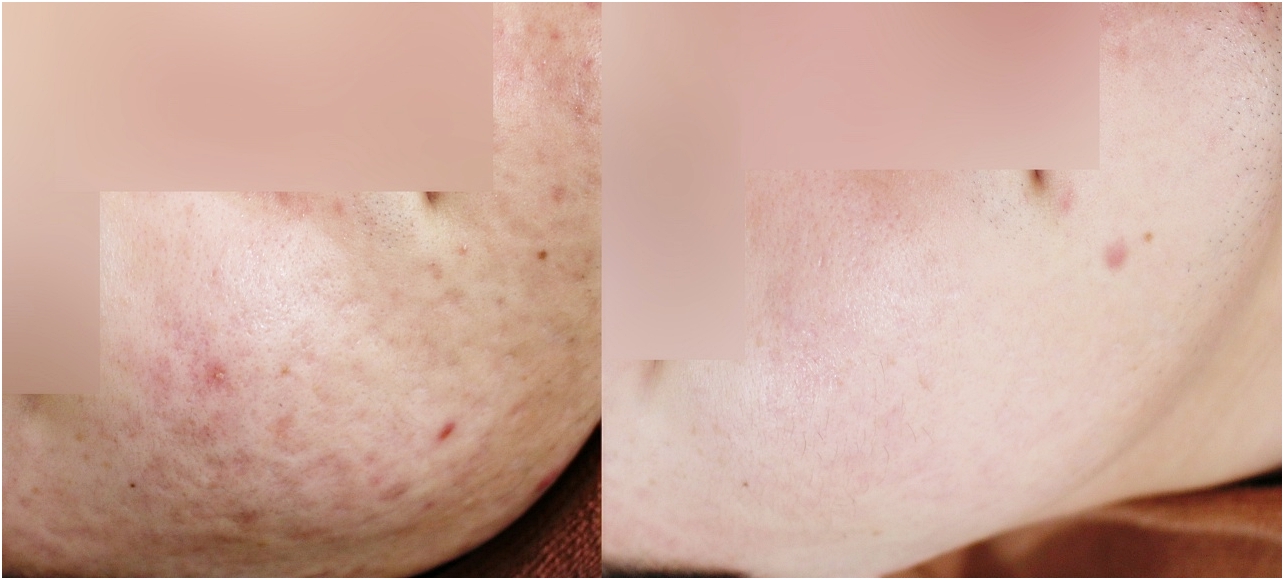 인천여드름흉터 볼 부분 정면 전후 변화