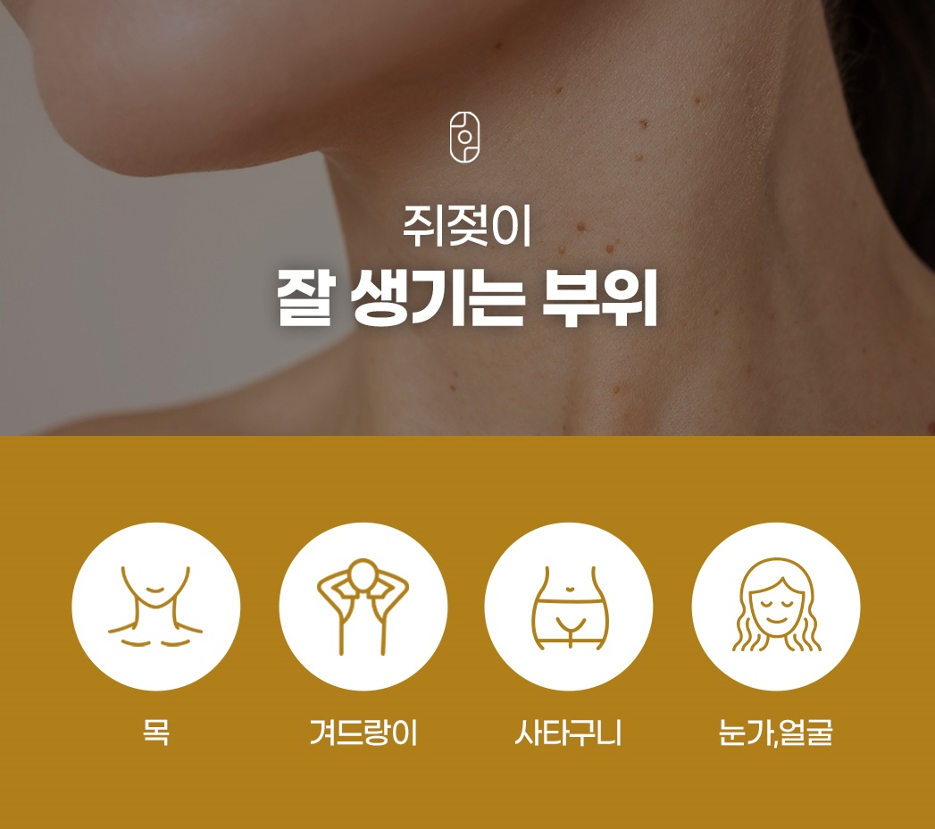 쥐젖이 잘 생기는 신체 부위 - 목, 겨드랑이, 사타구니, 눈가 및 얼굴