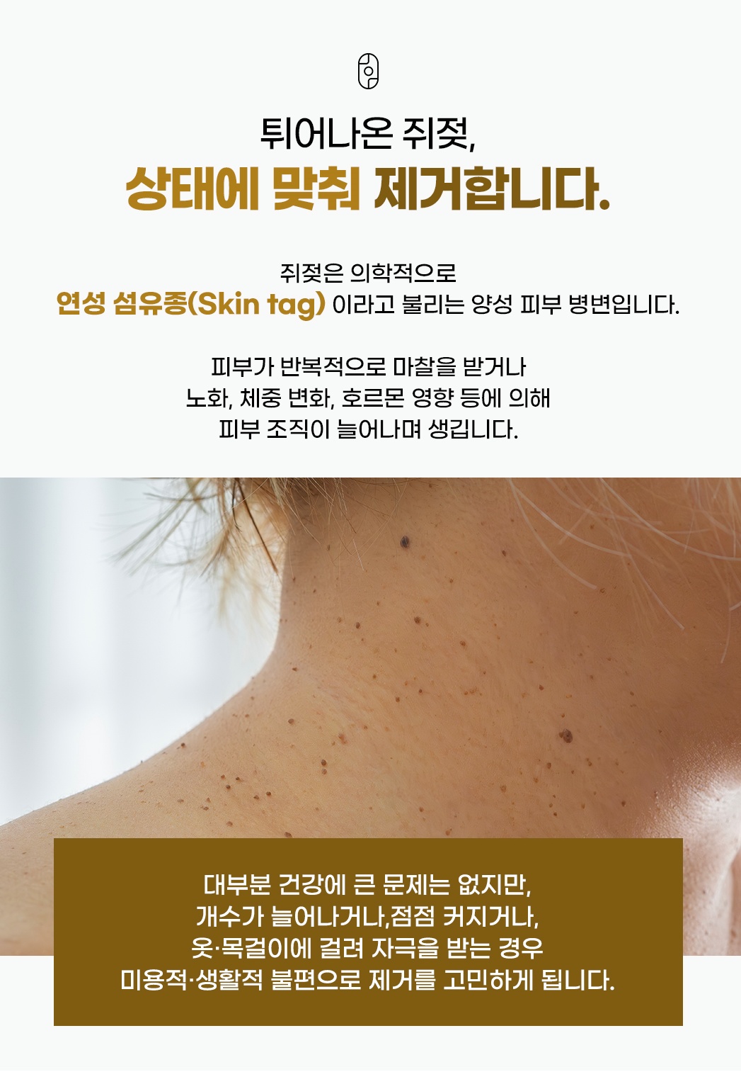 목에 튀어나온 쥐젖(연성 섬유종) 상태, 노화와 마찰로 인한 발생 원인 설명