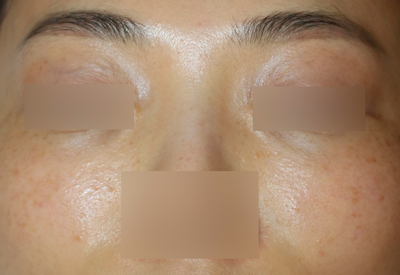 인천한관종 치료 전 눈 밑 및 뺨 부위 피부 상태