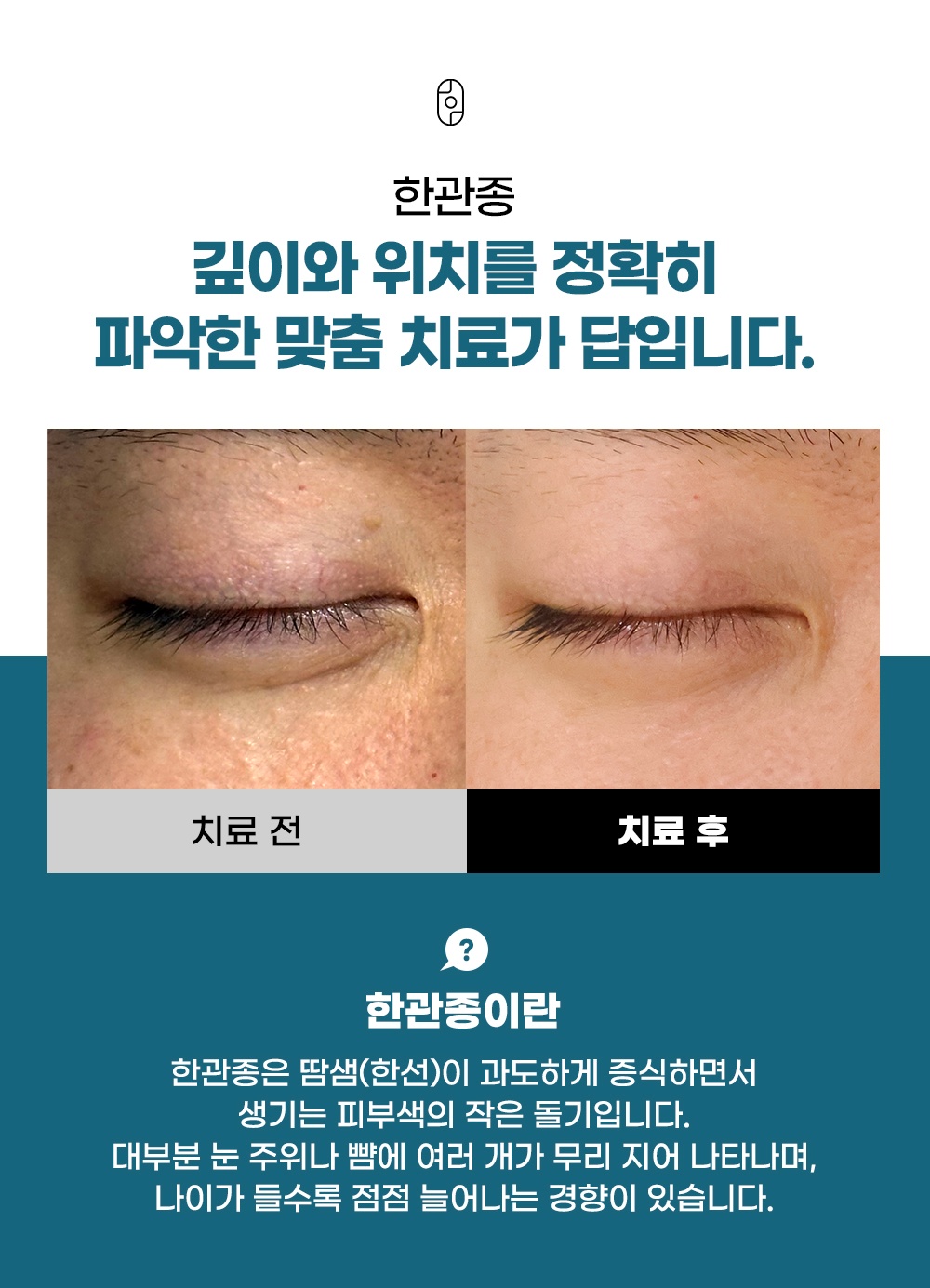 눈 주변 눈가 한관종 치료 전후 임상 비교