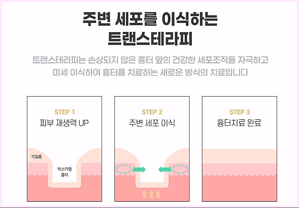 주변 세포를 이식하는 트랜스테라피 시술 3단계