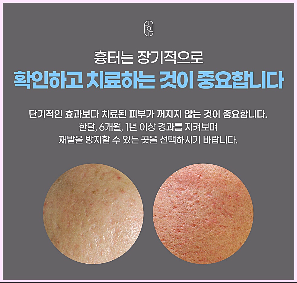 인천흉터치료 장기적으로 확인하고 치료하는 것이 중요하다는 안내 이미지