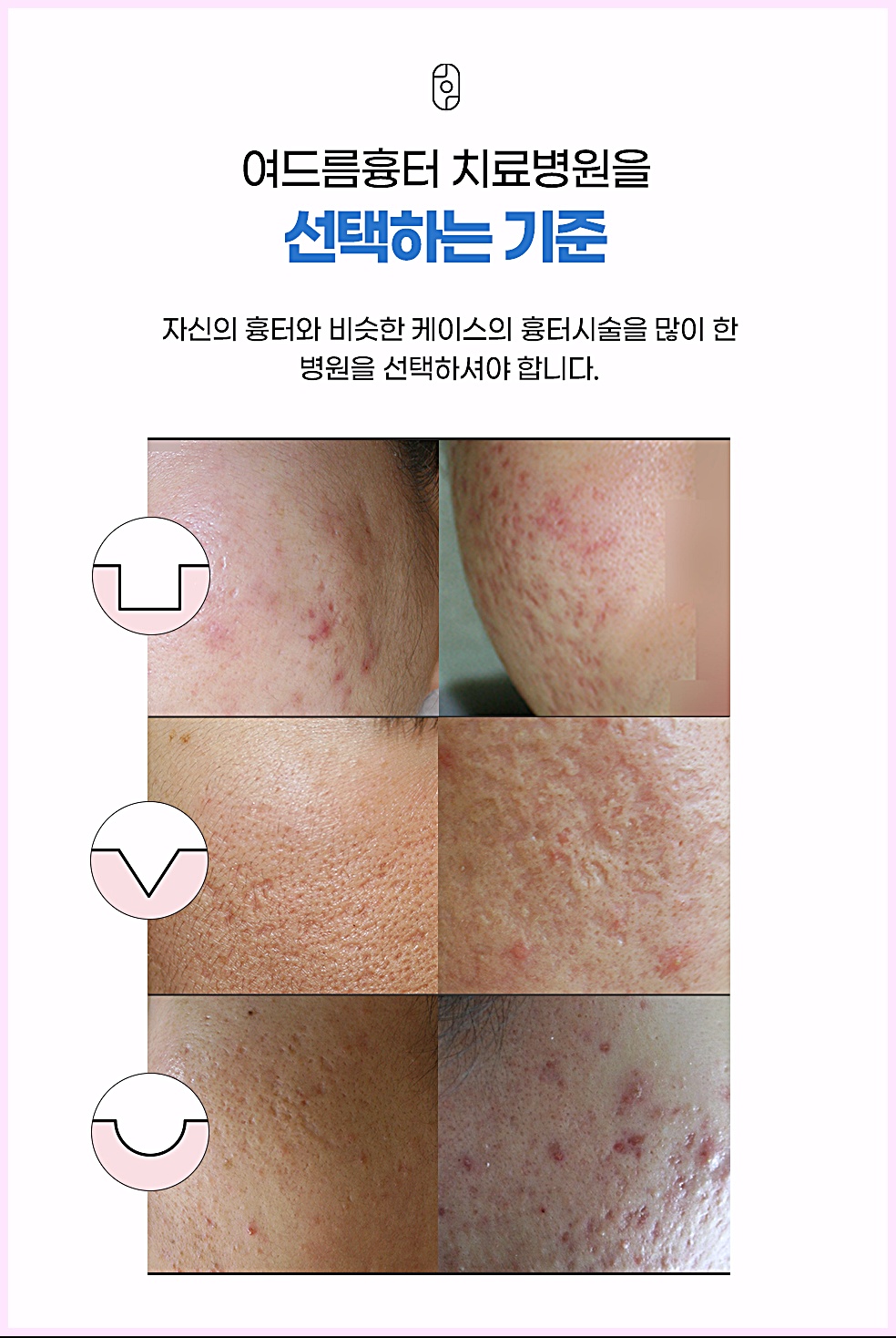 인천 여드름흉터 치료병원 선택 기준 안내