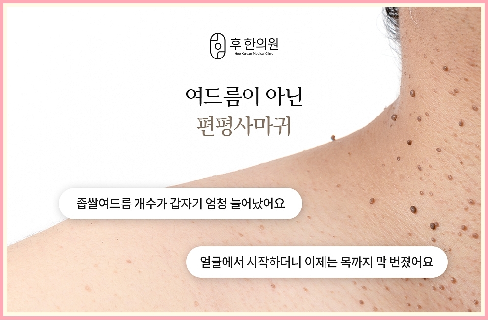 편평사마귀의 정의와 생김새 설명