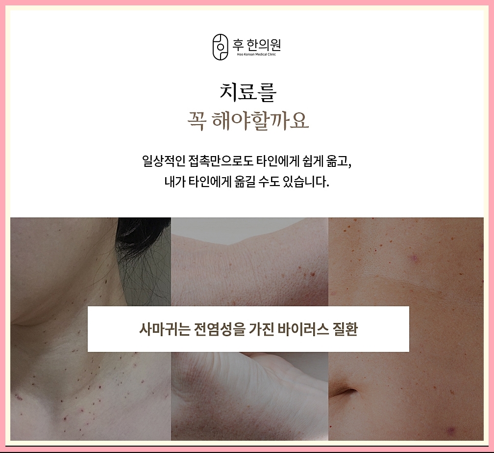 편평사마귀를 번지기 전에 치료해야 하는 이유