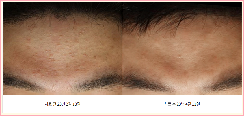 이마 편평사마귀 치료 전후