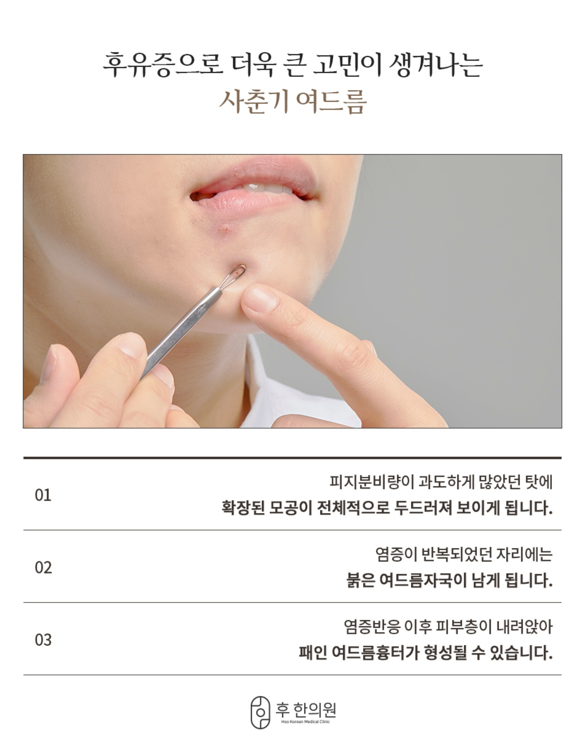 후한의원 사춘기 여드름 후유증 (모공 확장, 붉은 자국, 패인 흉터) 발생 원인