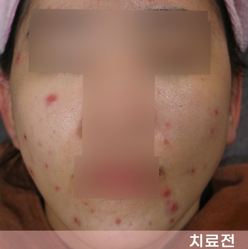 이마와 볼에 난 붉은 여드름 치료 전 정면 사진