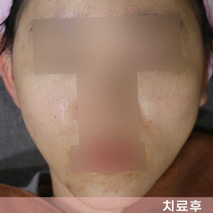 치료 후 가라앉은 피부결을 보여주는 정면 비교 사진