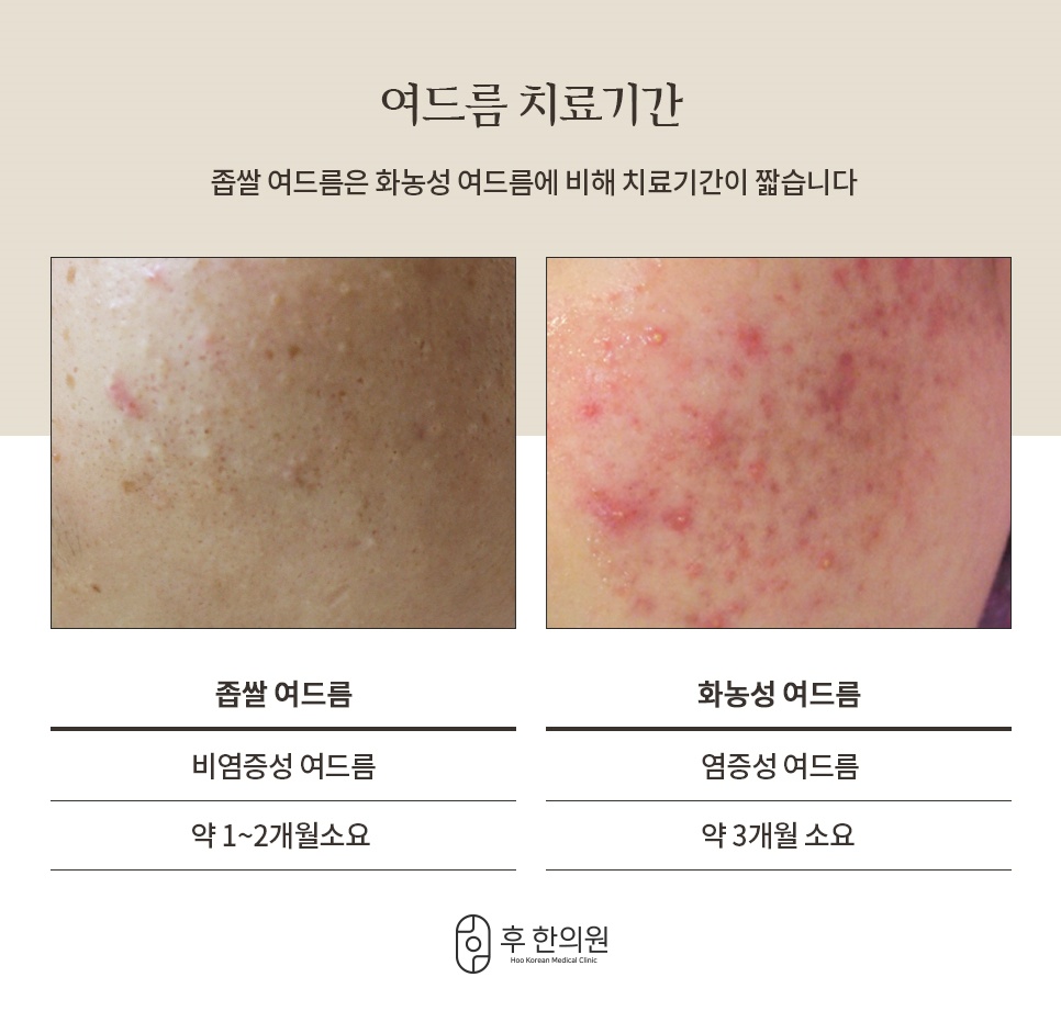 좁쌀여드름과 화농성 여드름의 치료 소요 기간 비교