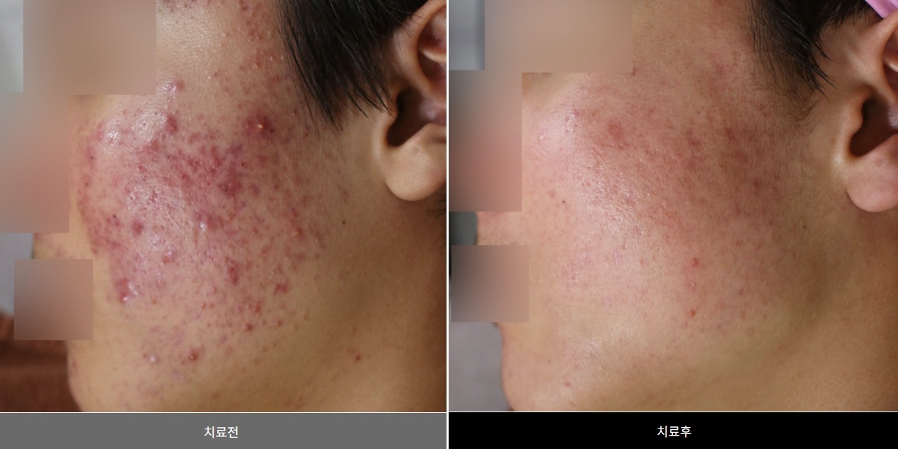 볼 부위 화농성 여드름 치료 전후 비교 사진