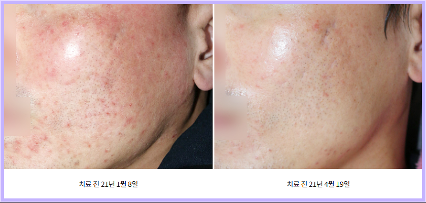 인천주사피부염 치료 전후, 양볼의 붉은기가 옅어진 변화