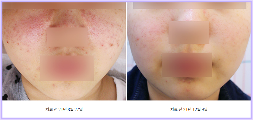 후한의원 인천점 주사피부염 치료 전후 볼 홍조 비교
