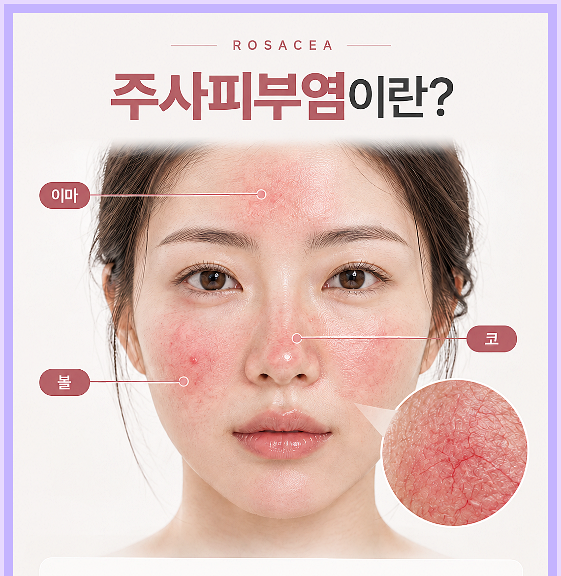 인천주사피부염 정의, 얼굴 중앙의 지속되는 붉은기와 혈관 확장