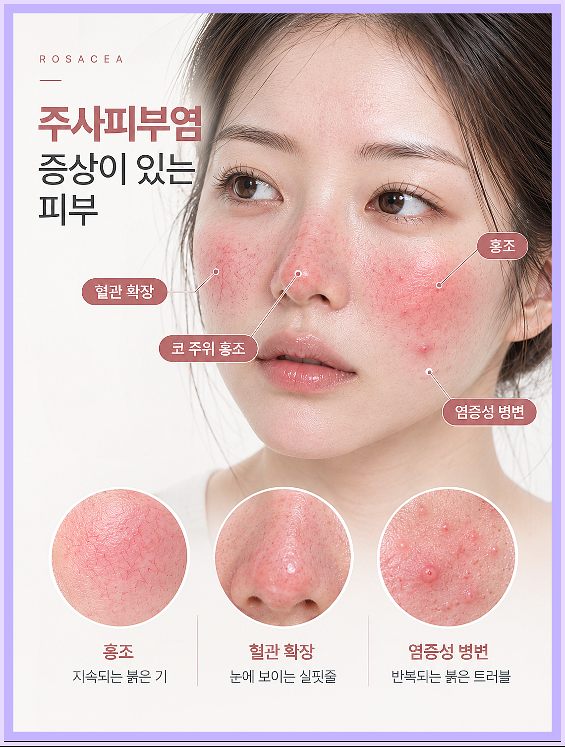 주사피부염 대표 증상, 뺨과 코의 붉은기와 모세혈관 확장, 좁쌀 발진