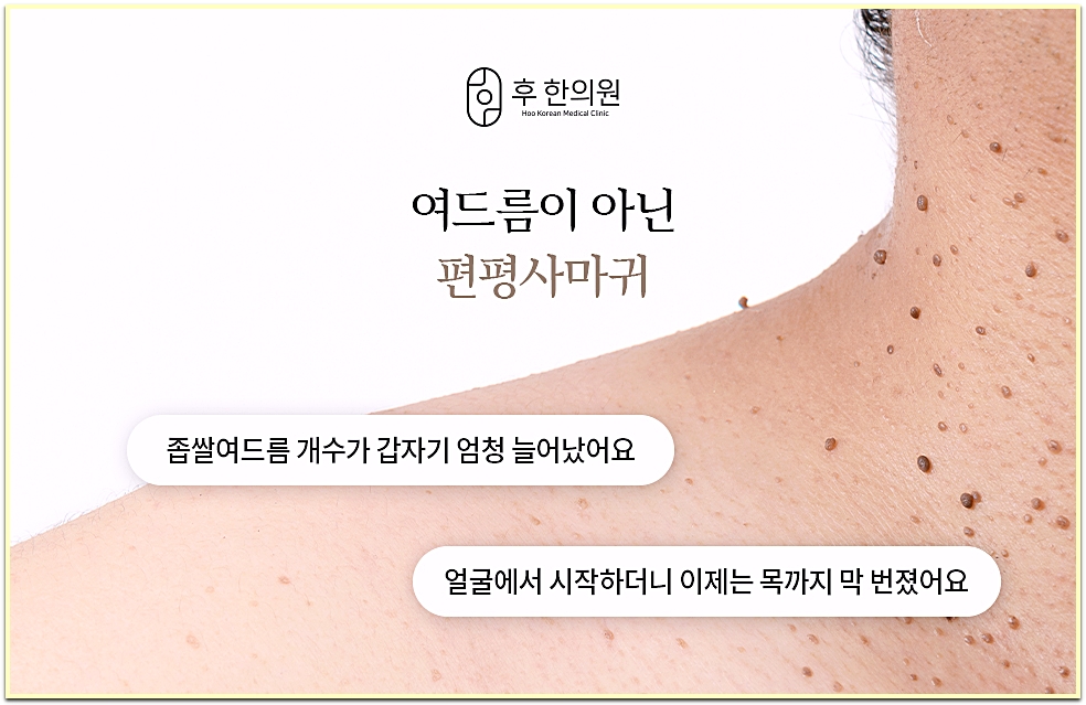 구월동편평사마귀 여드름과 혼동되는 얼굴·목 편평사마귀 설명 이미지