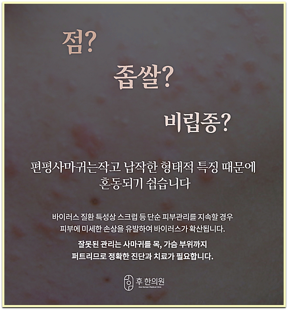 구월동편평사마귀 점·좁쌀여드름·비립종과 혼동되기 쉬운 편평사마귀 특징 설명