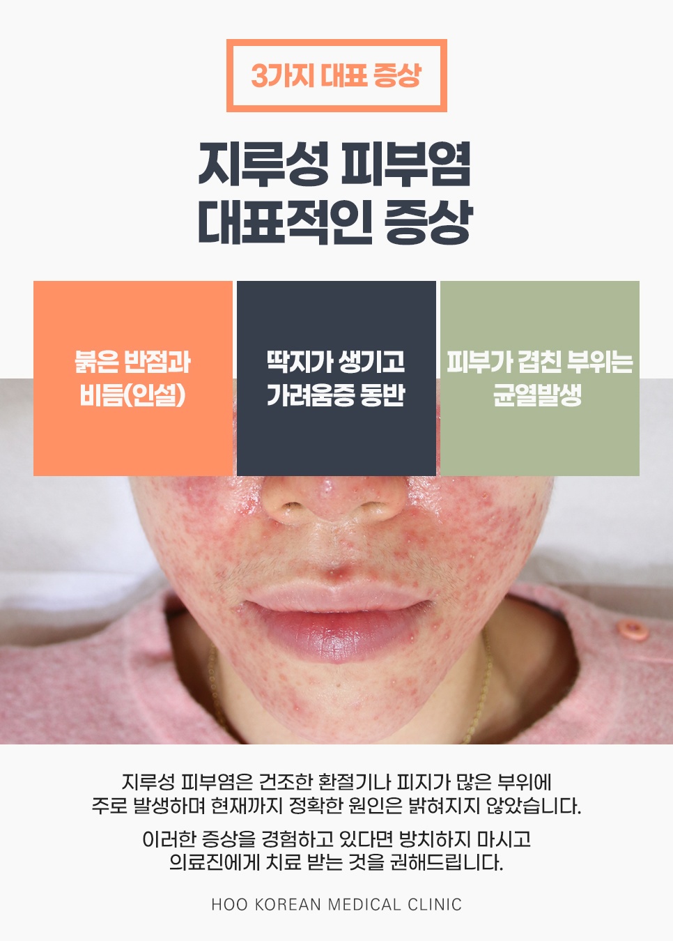 붉은 반점과 비듬, 딱지와 가려움, 접히는 부위 균열로 보는 지루성피부염 대표 증상 3가지