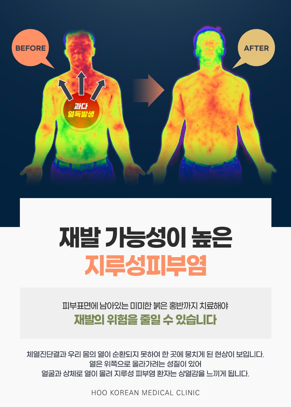 상체에 몰린 열이 고르게 퍼진 체열진단 전후 이미지와 재발 가능성 안내