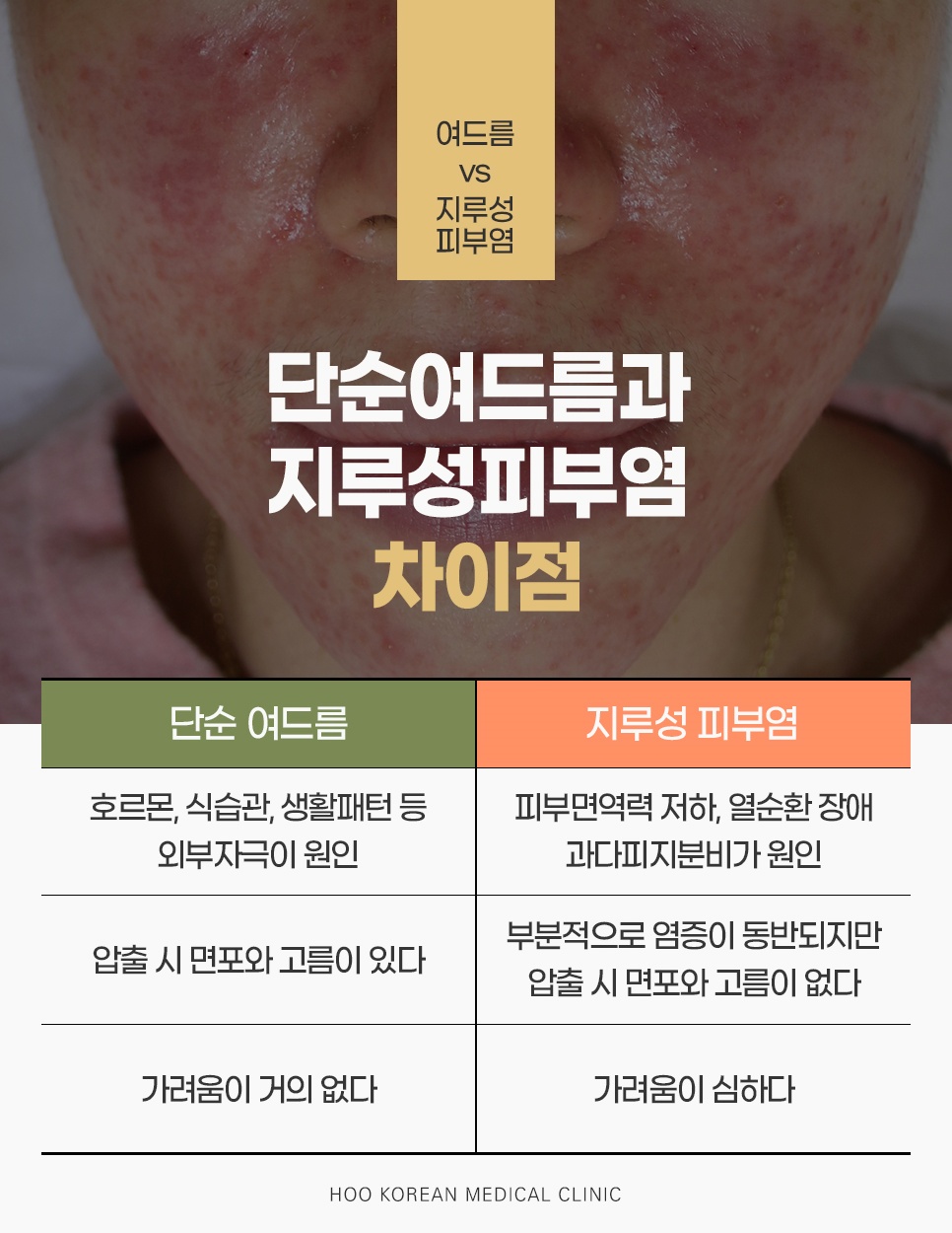 호르몬·생활습관이 원인인 단순여드름과 면역력 저하·열순환 장애가 원인인 지루성피부염 비교표