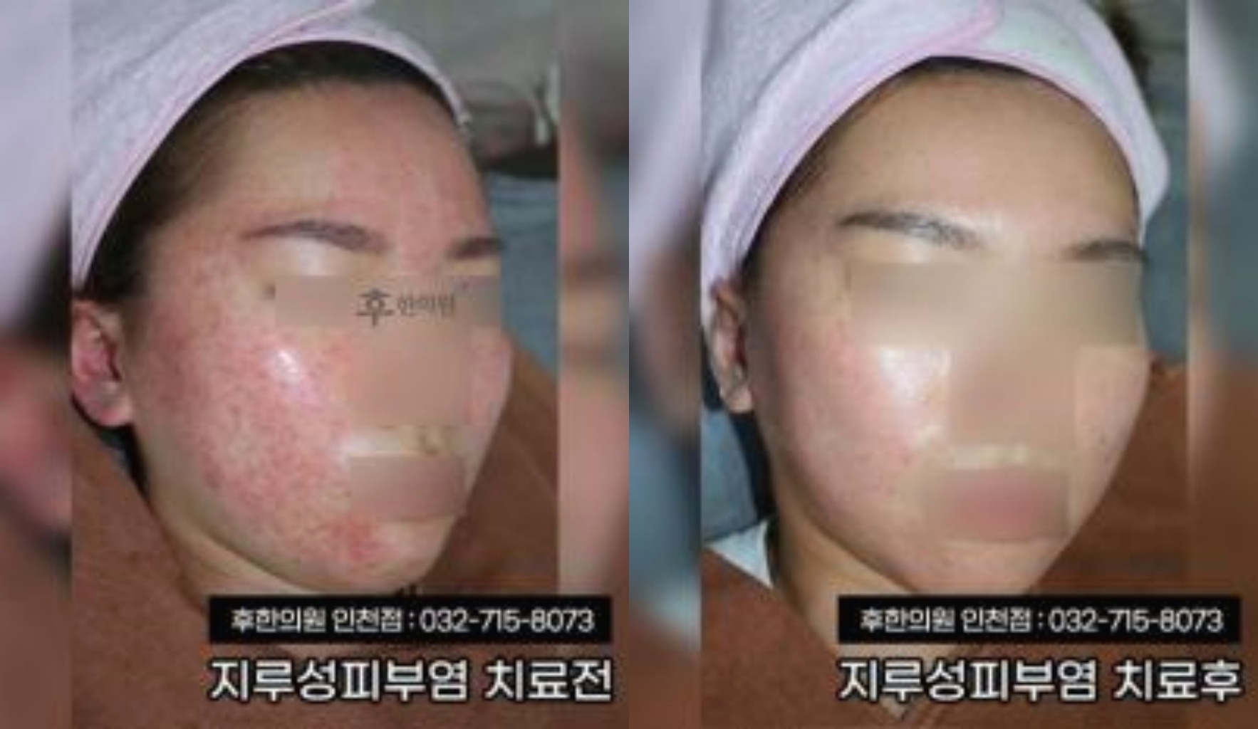 수건을 두른 환자의 붉은 볼과 턱선이 맑아진 인천점 지루성피부염 치료 전후
