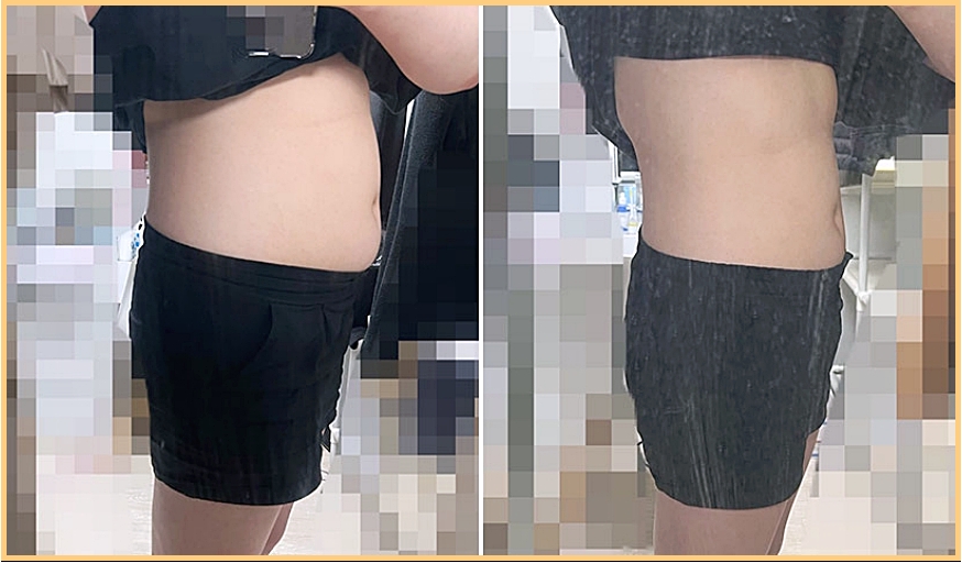 비움탕 3일 프로그램 전후 옆모습 체형을 나란히 비교한 사진