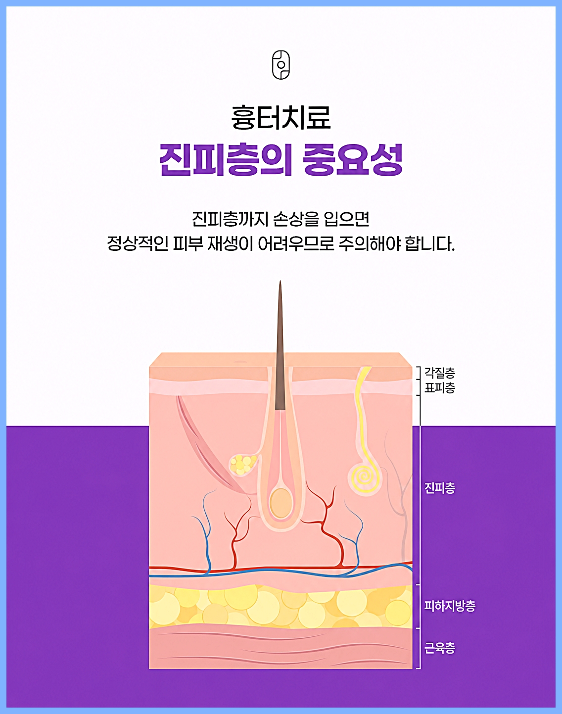 인천여드름흉터치료 진피층 손상과 흉터 재생 원리 단면도