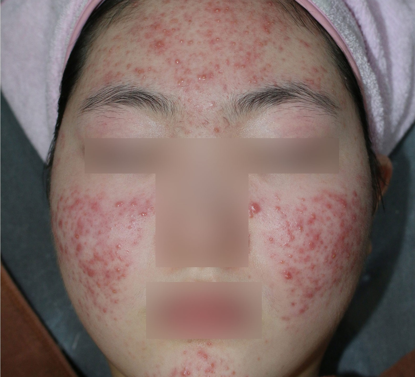 인천 여드름 압출 치료 전, 이마와 양볼, 턱에 좁쌀여드름과 화농성 여드름이 퍼진 얼굴
