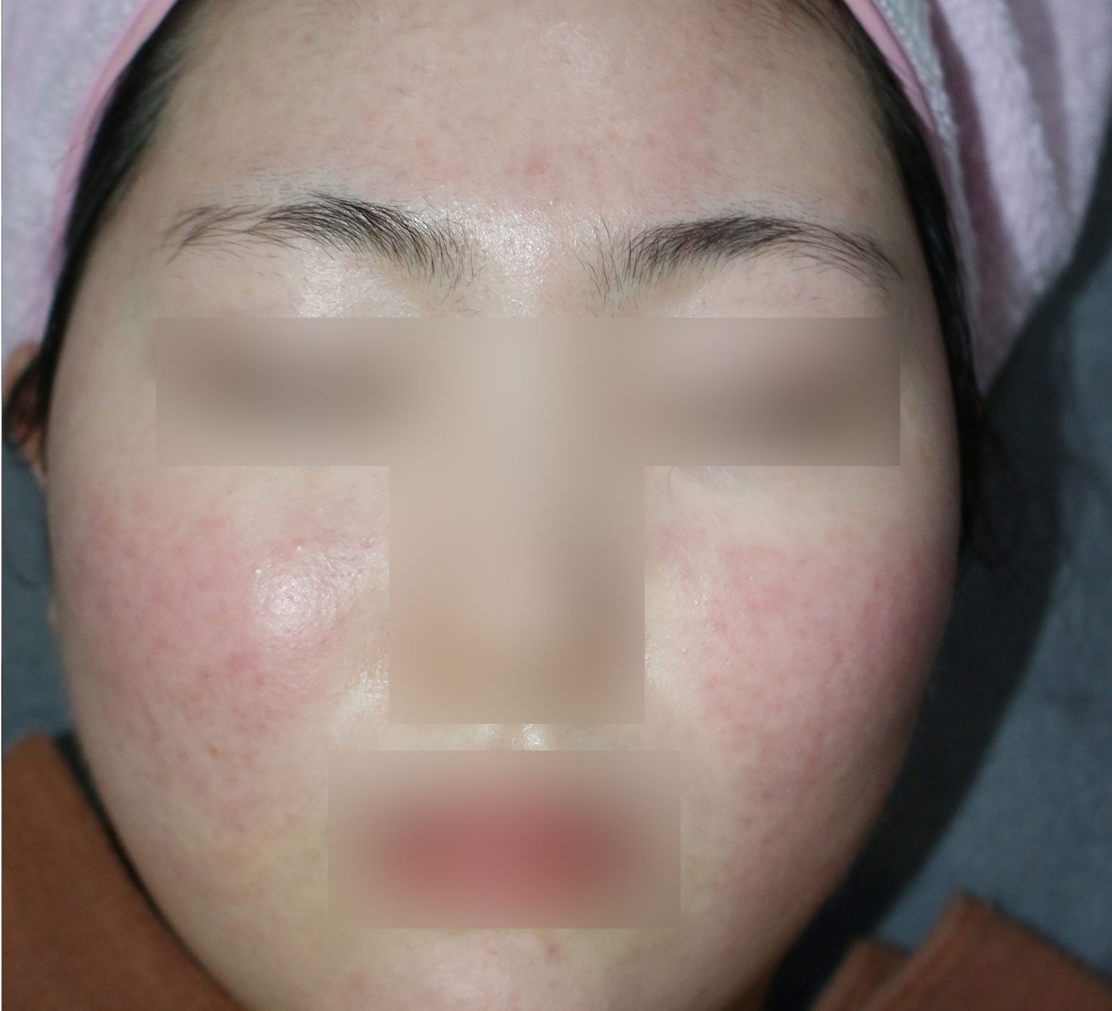 인천 여드름 압출과 맞춤 케어 7개월 후, 염증성 여드름이 가라앉고 피부결이 정돈된 얼굴